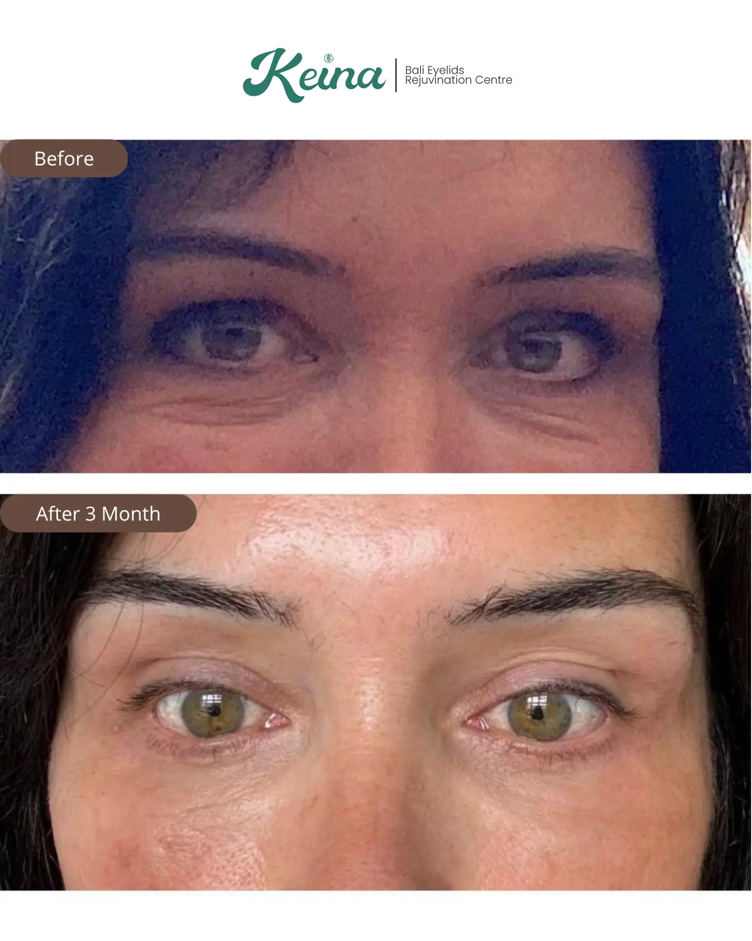 Lower Blepharoplasty