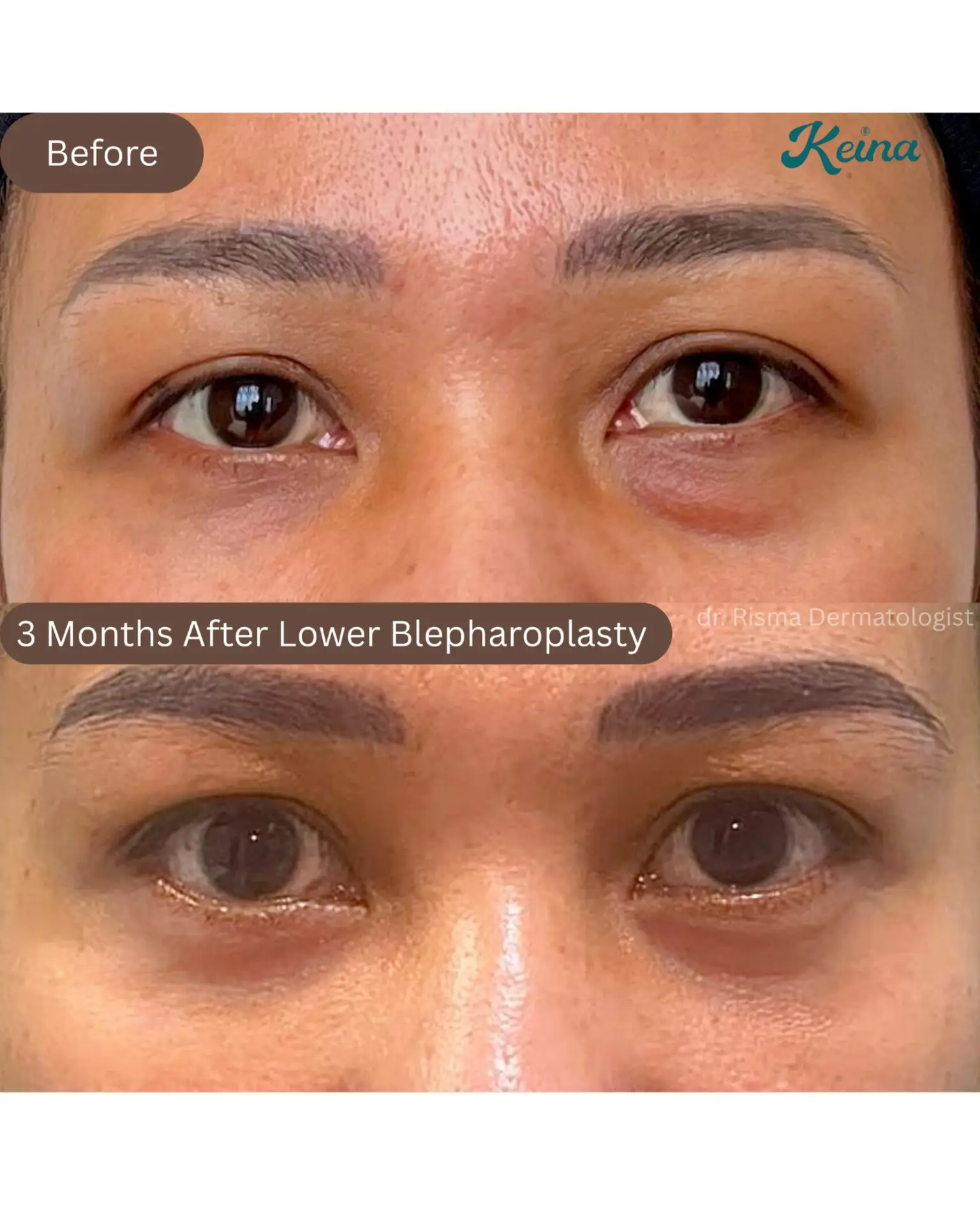 Lower Blepharoplasty
