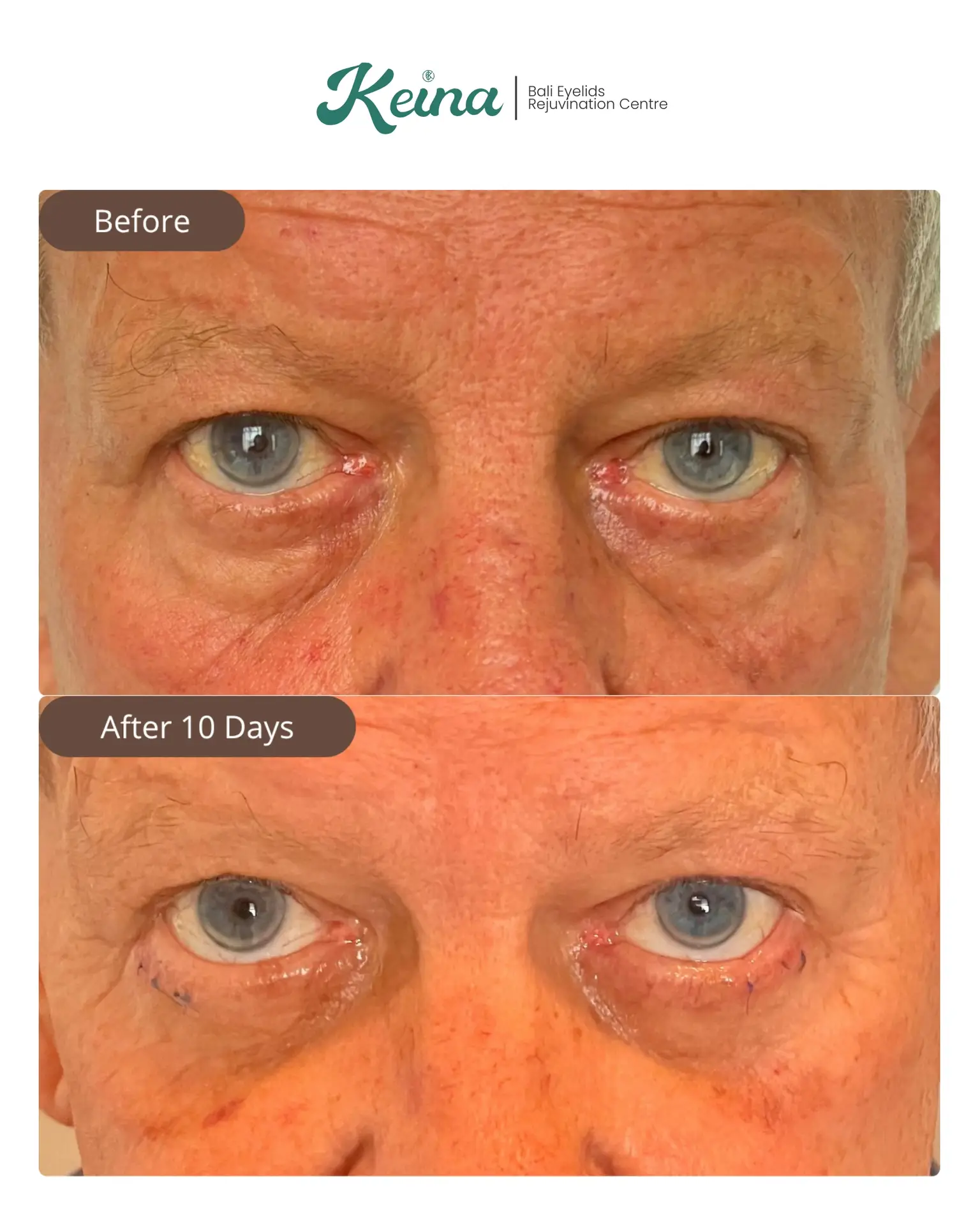 Lower Blepharoplasty