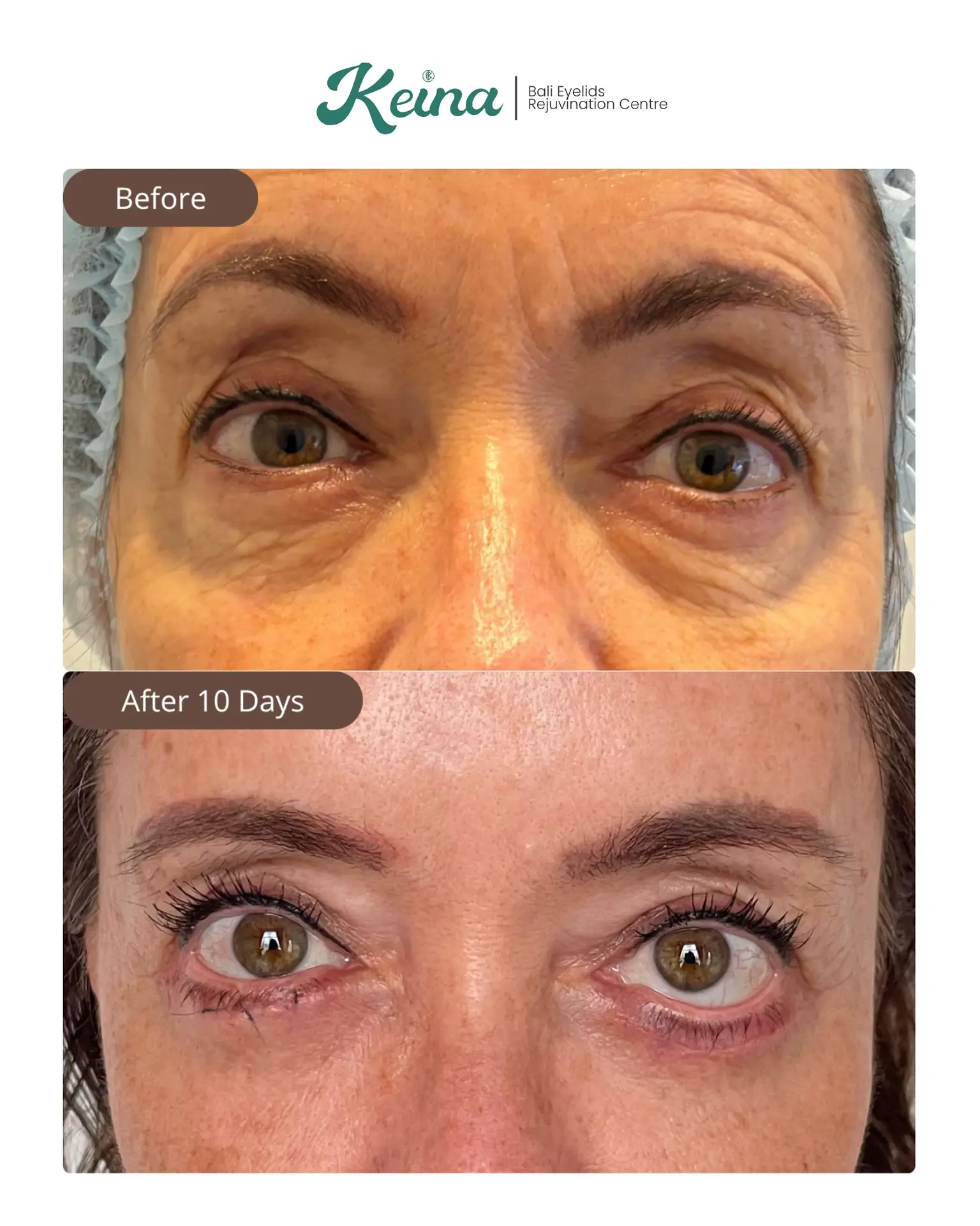 Lower Blepharoplasty