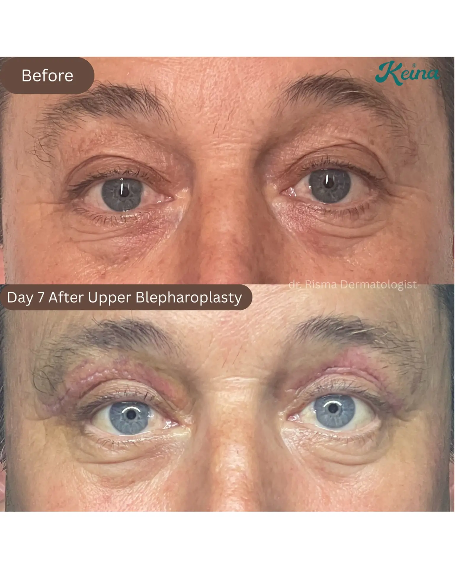 Upper Blepharoplasty
