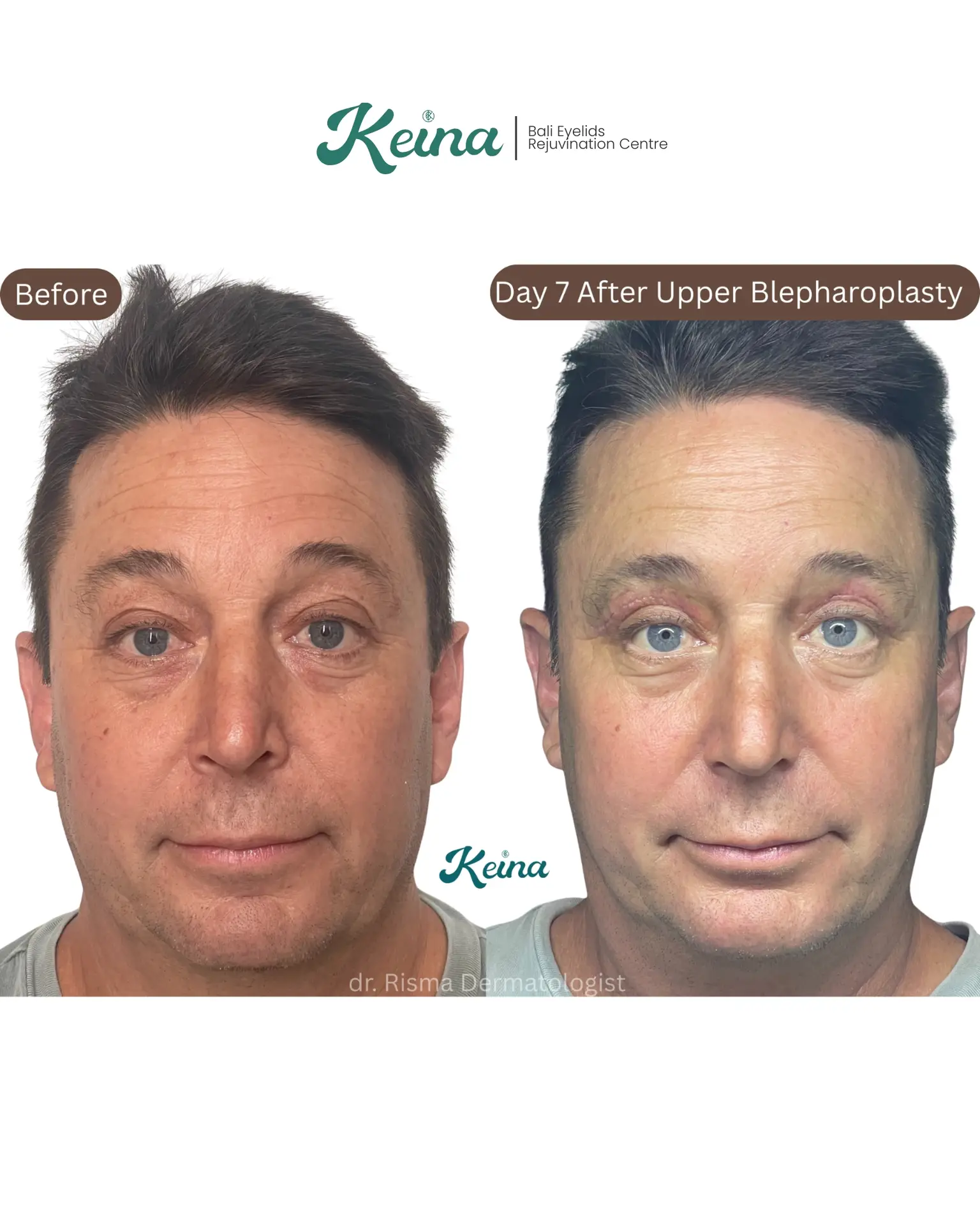 Upper Blepharoplasty