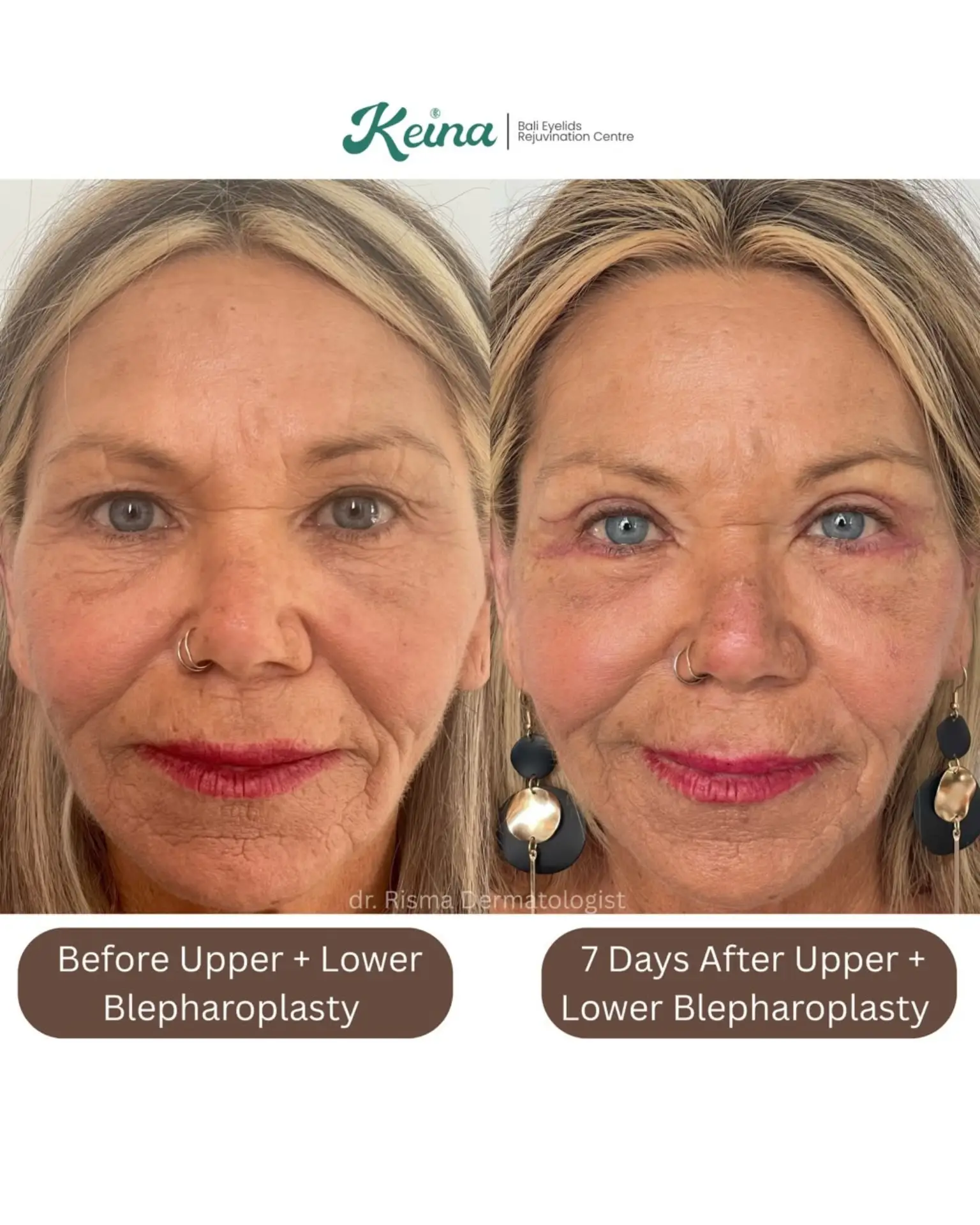 Upper & Lower Blepharoplasty