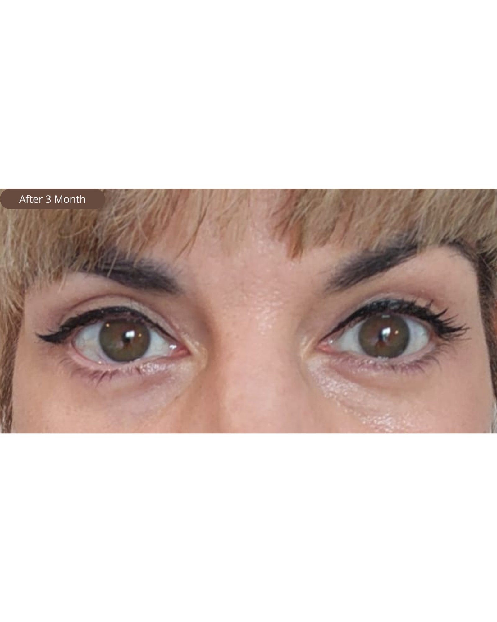 Upper & Lower Blepharoplasty