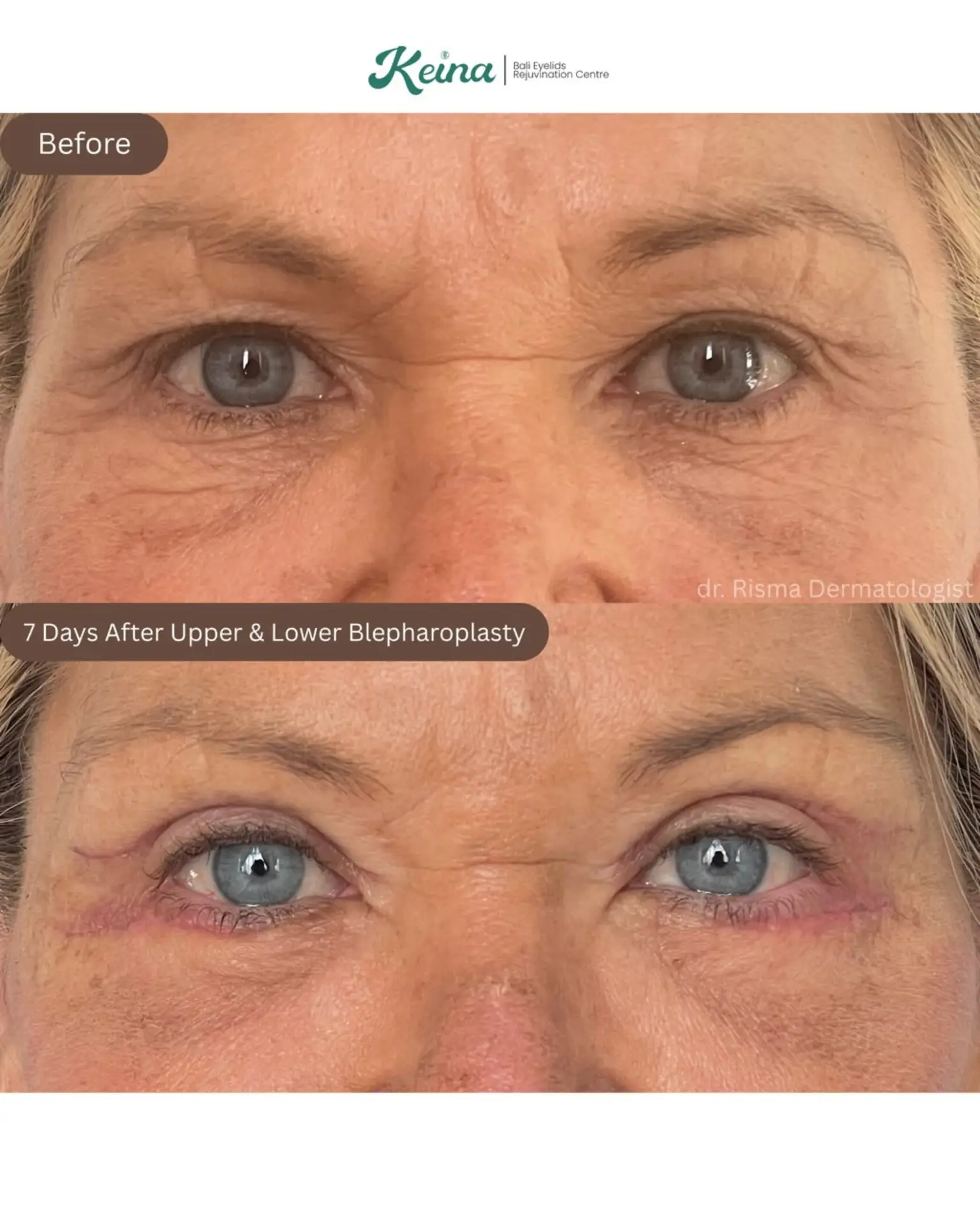 Upper & Lower Blepharoplasty