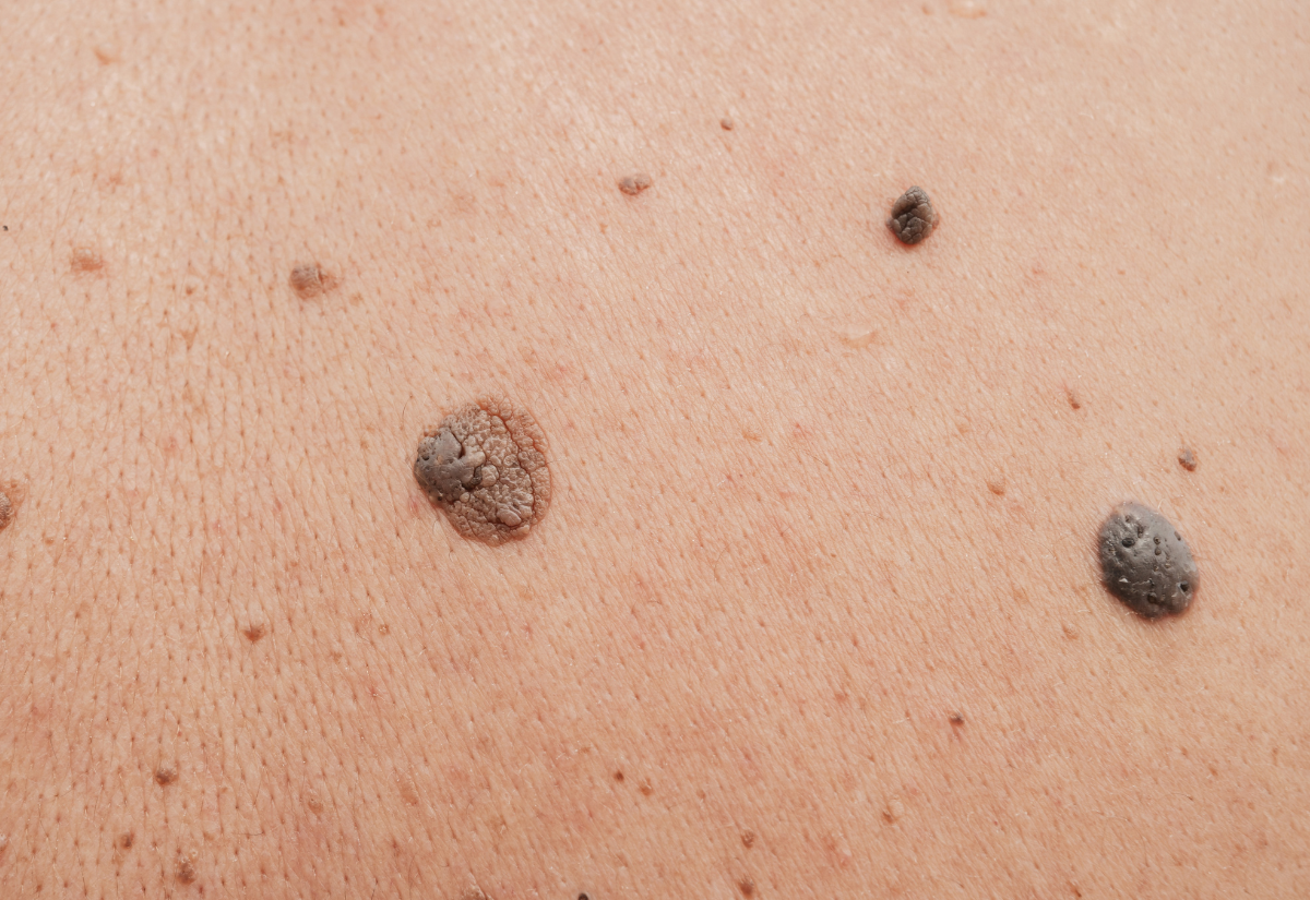 Rejuran HB treatment