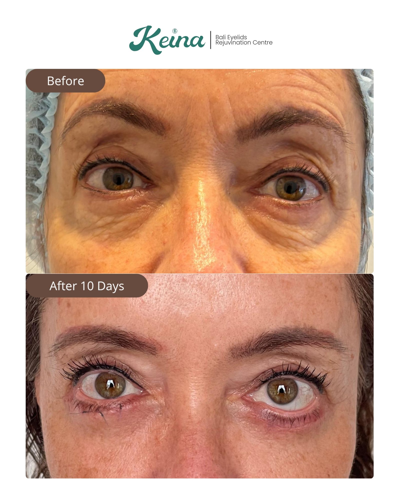 Lower Blepharoplasty Keina Clinic