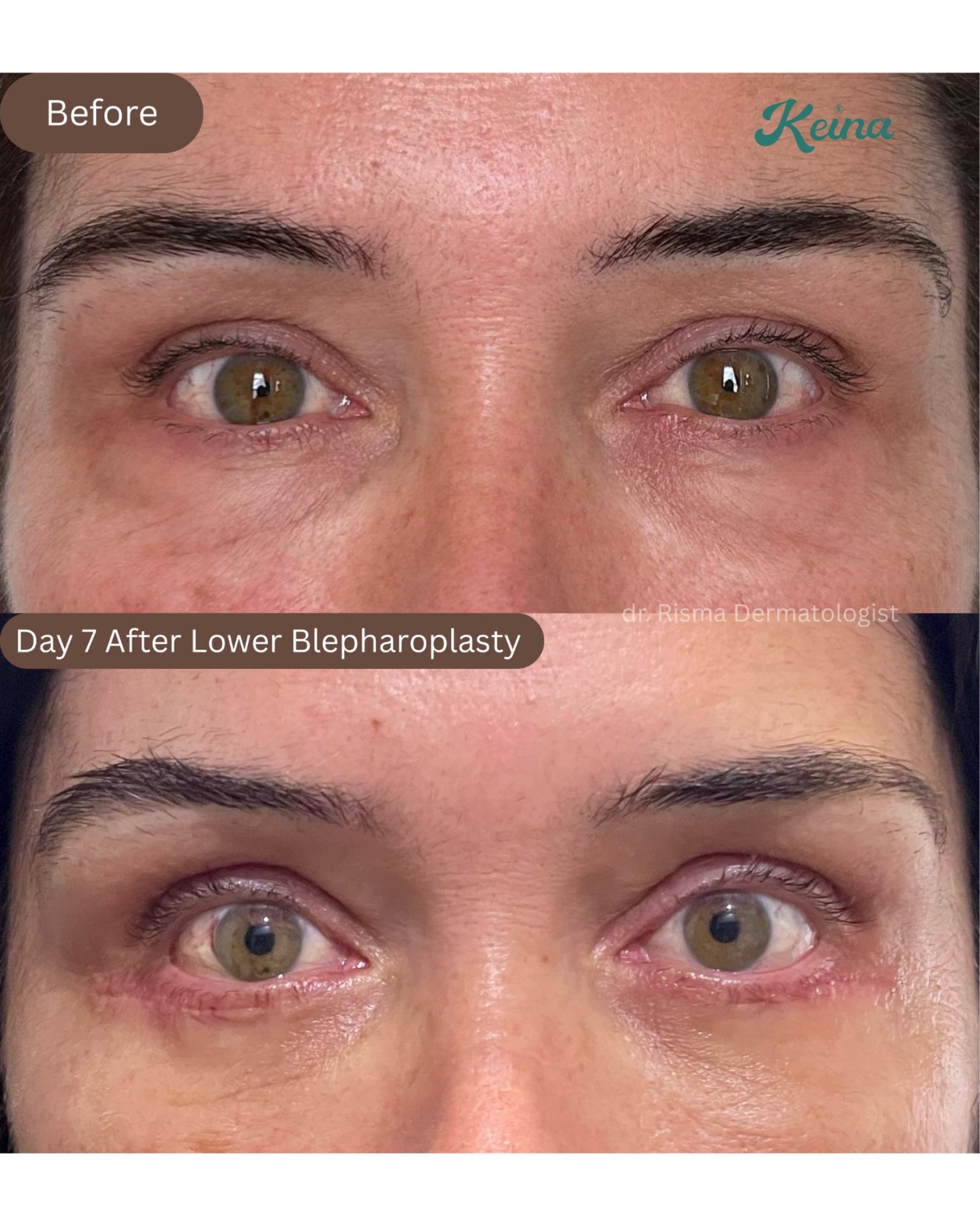 Lower Blepharoplasty Keina Clinic