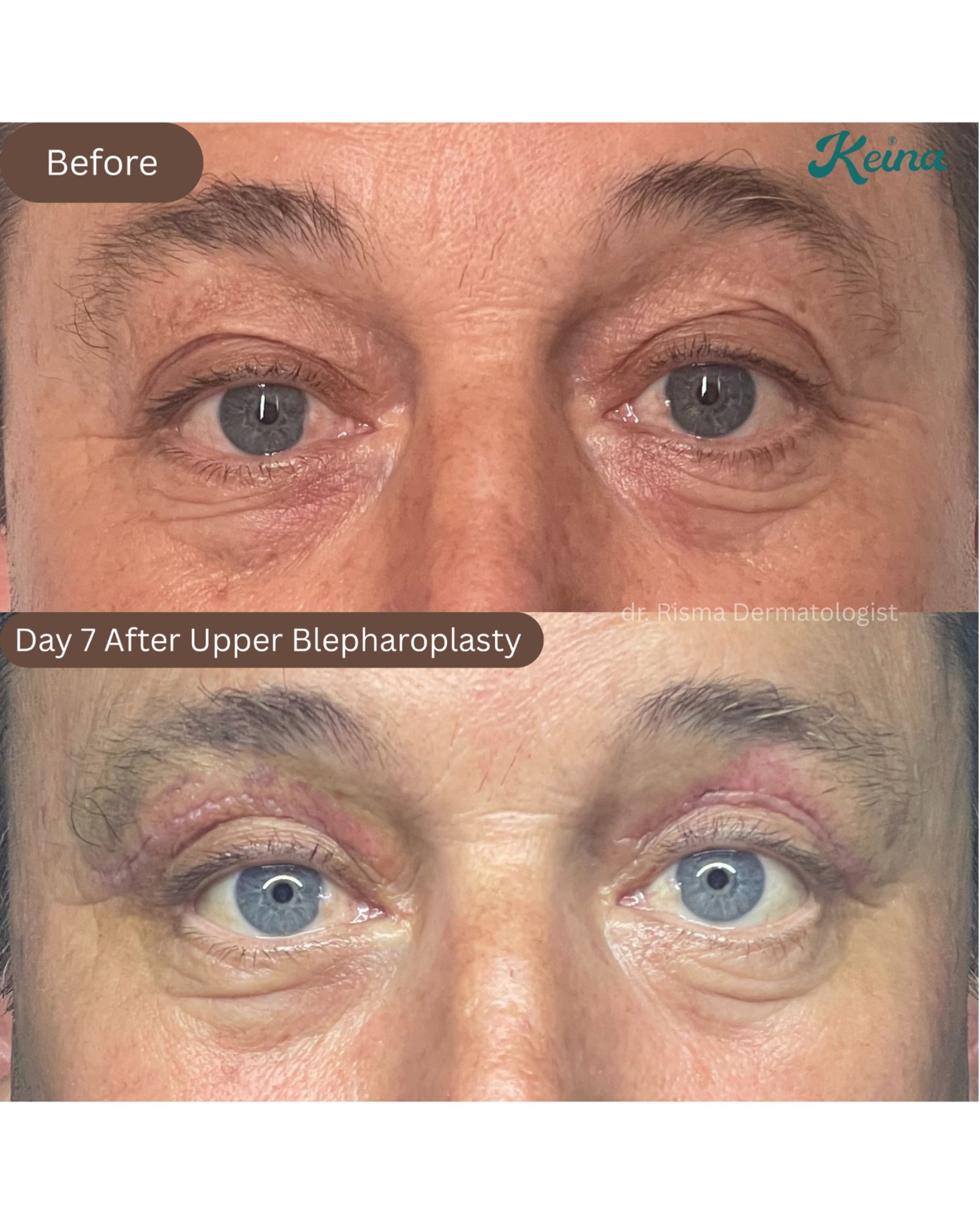 Upper Blepharoplasty Keina Clinic