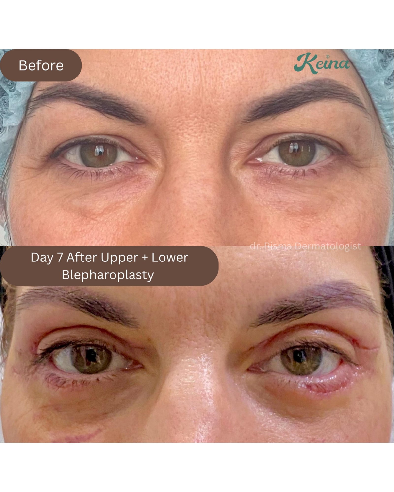 Upper and Lower Blepharoplasty Keina Clinic