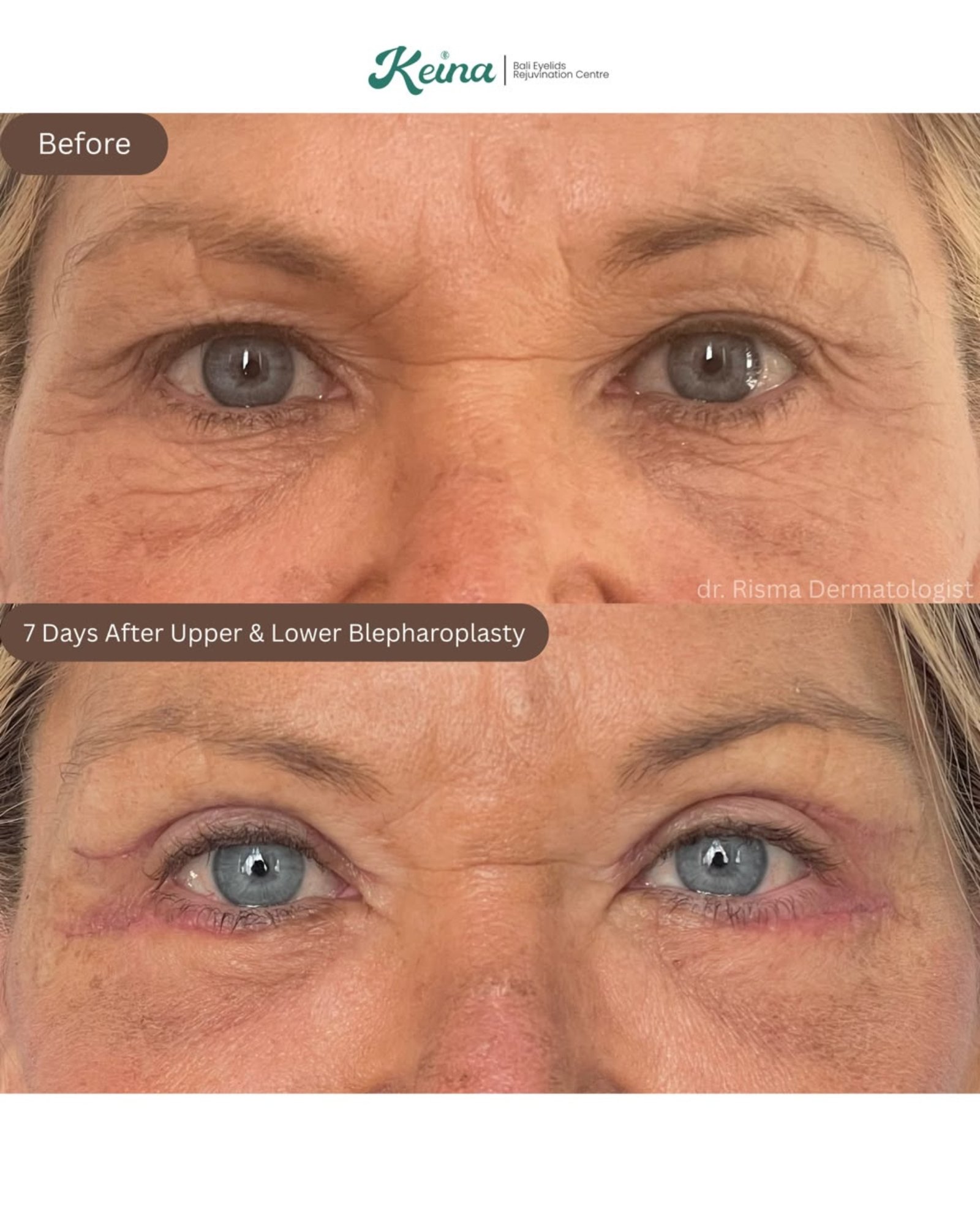 Upper and Lower Blepharoplasty Keina Clinic