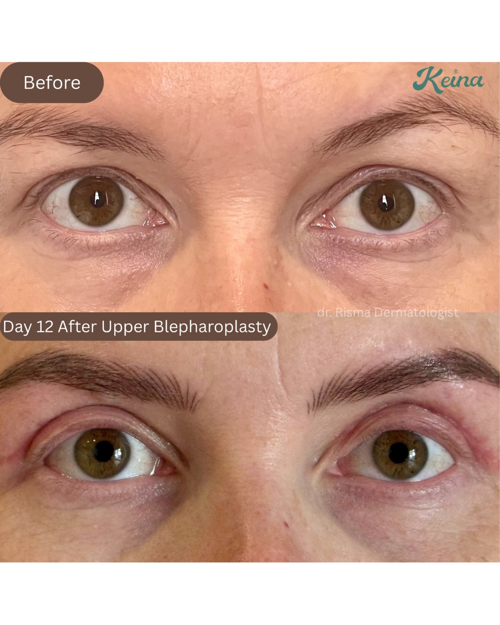 Upper Blepharoplasty Keina Clinic